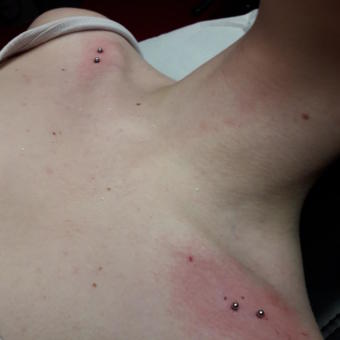 Implant transdermique par Dermogenese Tattoo