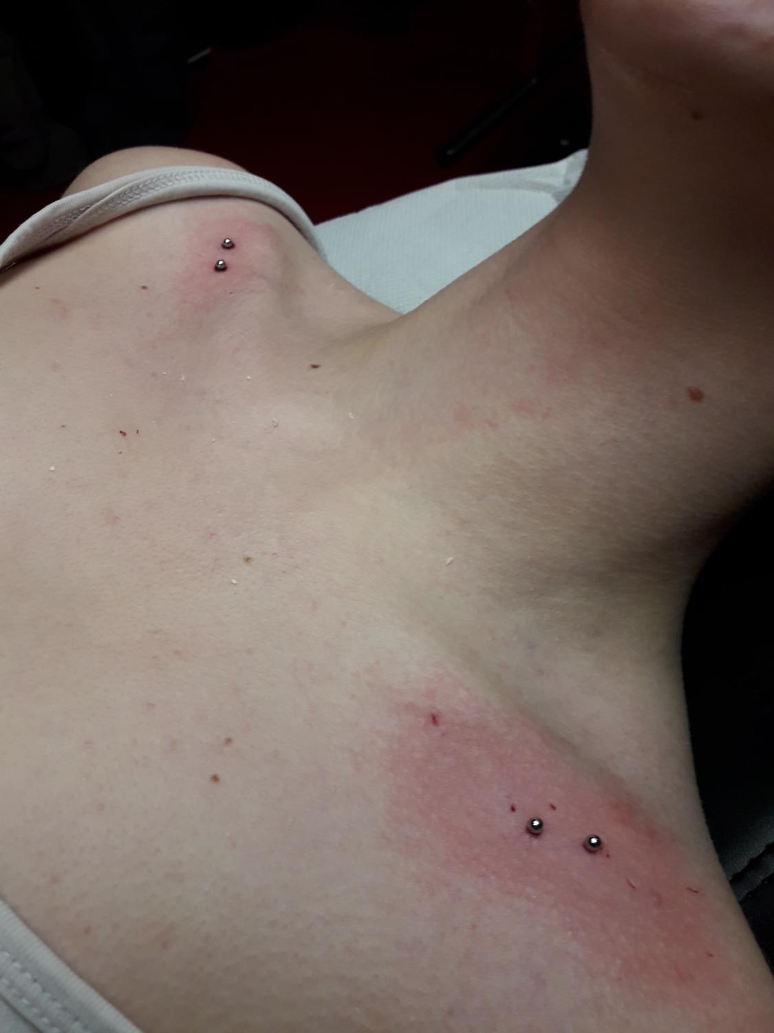 Implant transdermique par Dermogenese Tattoo Implant transdermique par Dermogenese Tattoo
