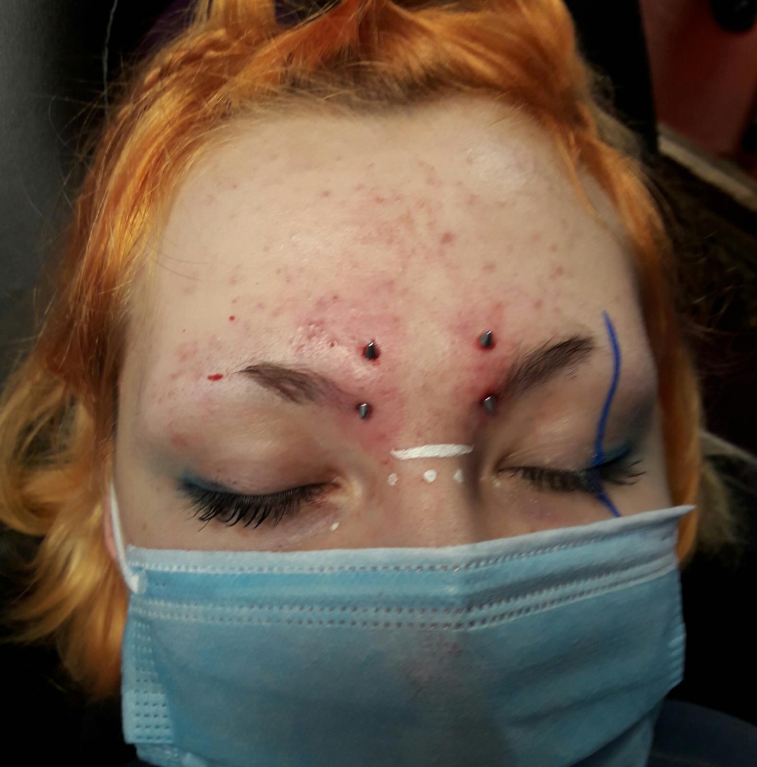 Implant transdermique par Dermogenese Tattoo Implant transdermique par Dermogenese Tattoo